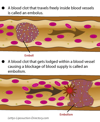 What are emboli?...